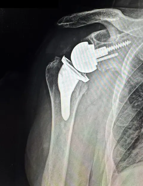 X-ray of a reverse shoulder replacement from Dr. Woodhead in Lincoln, NE