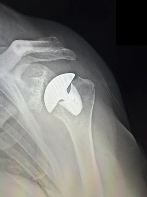 X-ray of a total shoulder replacement from Dr. Woodhead in Lincoln, NE
