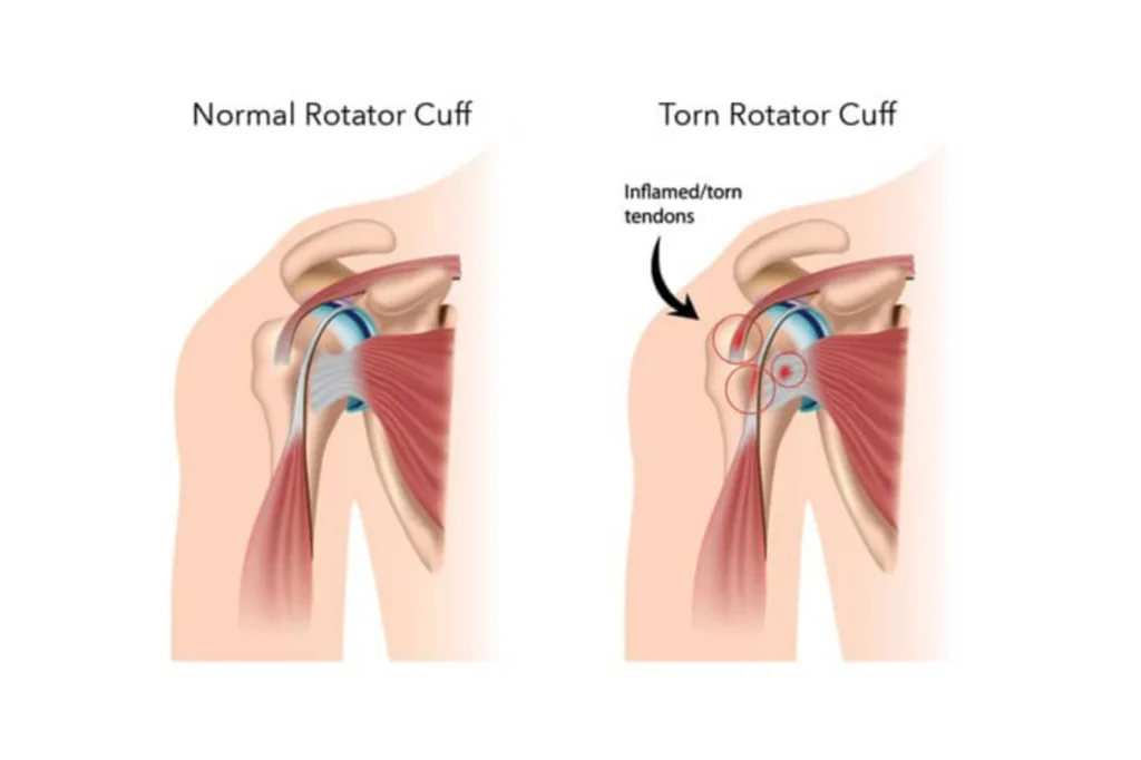 Rotator cuff tear