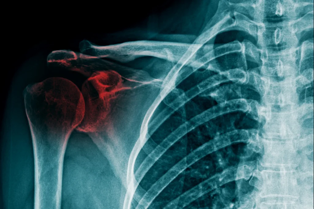 Shoulder fracture