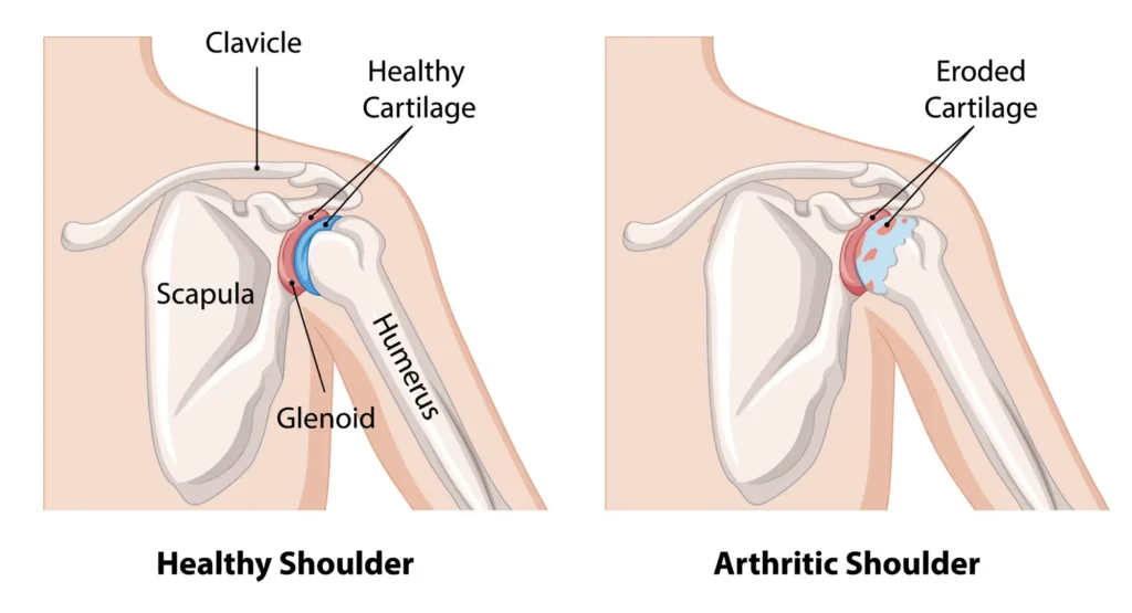 diagram of a healthy vs an arthritic shoulder, with a focus on the damaged cartilage.