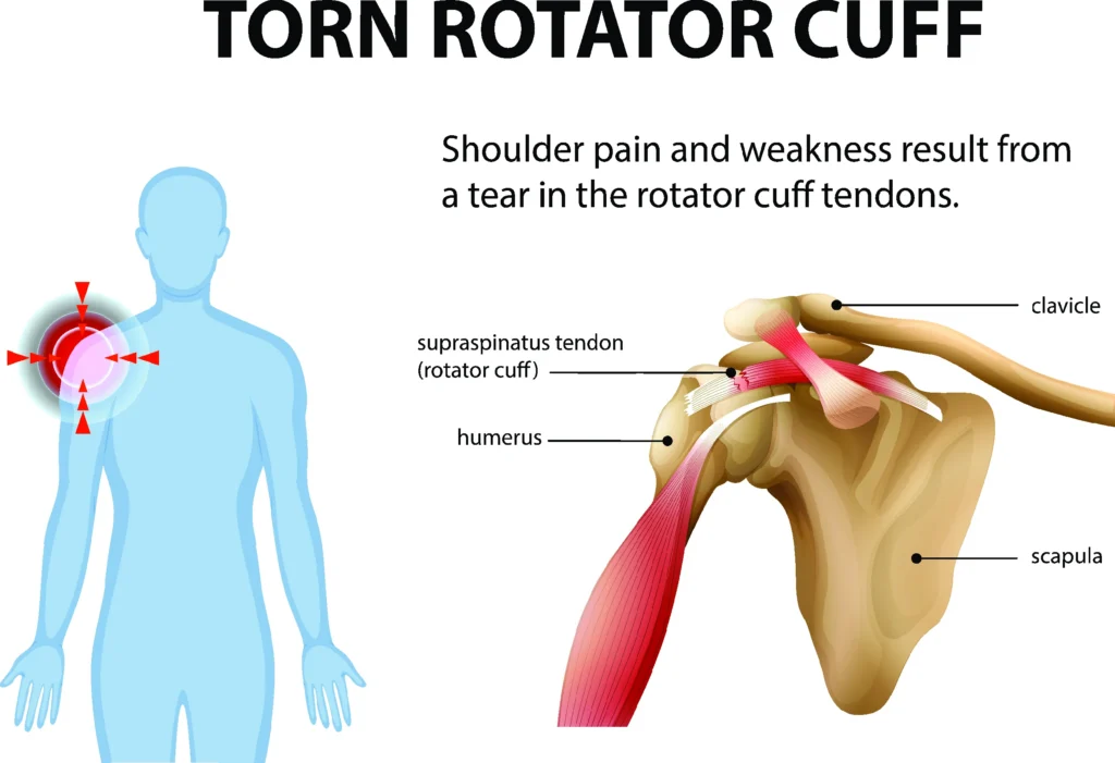 shutterstock_2568861207 Rotator cuff diagram, showing where it is in the body and where the tendon tear is in the shoulder.
