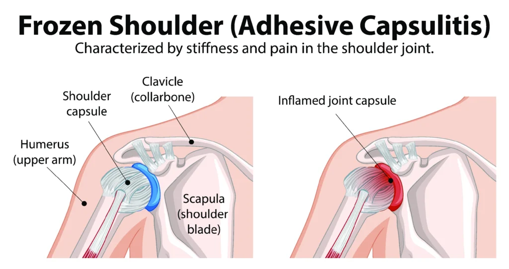 frozen_shoulder_diagram diagram of a frozen shoulder, comparing a healthy shoulder to a frozen shoulder.