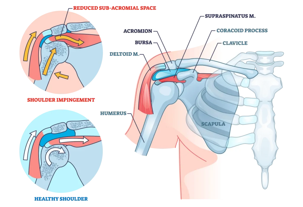 shoulder impingement diagram