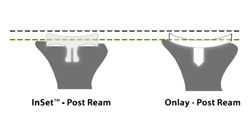 Diagram of InSet® glenoid vs traditional onlay