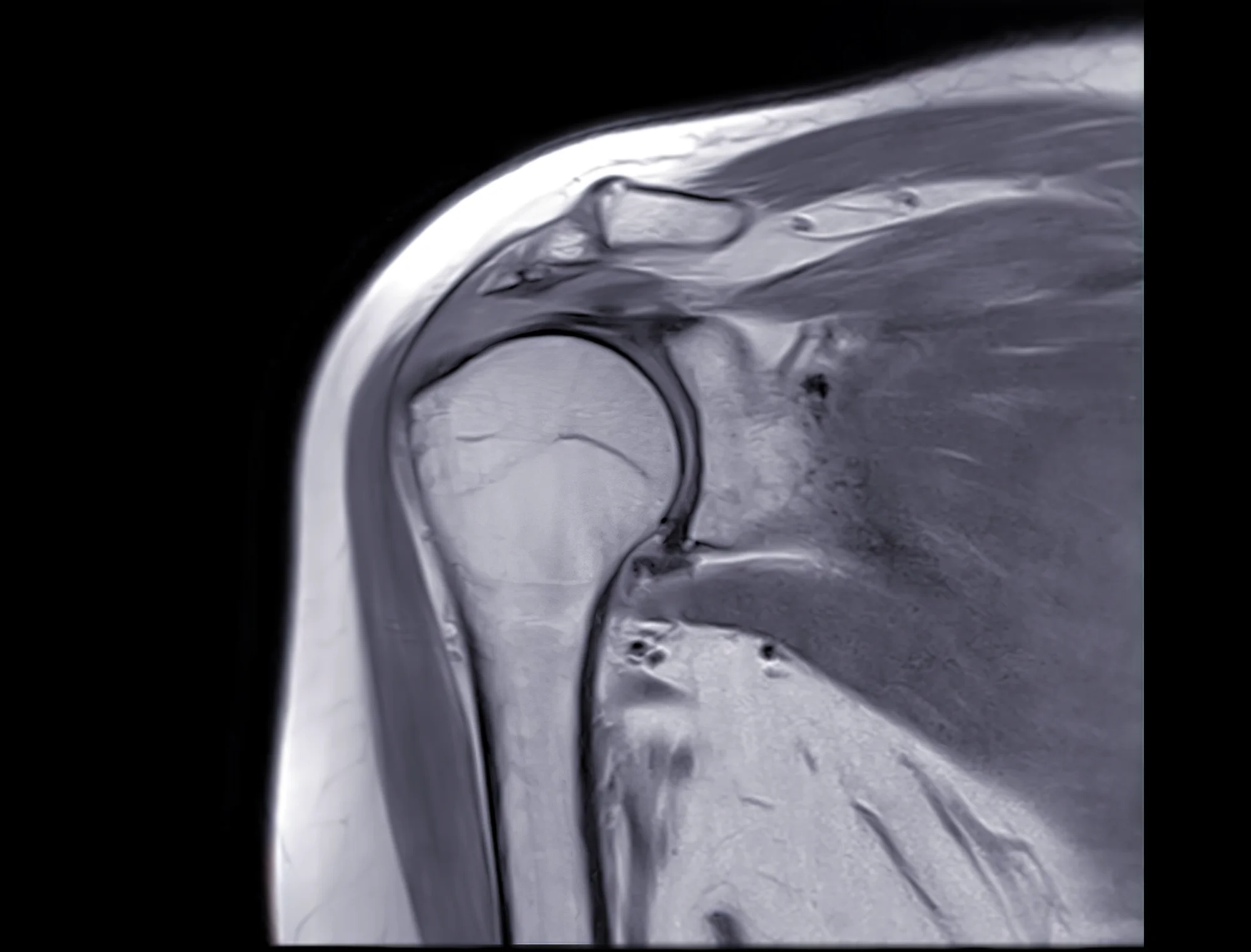 Shoulder MRI scan