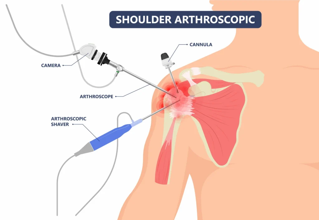 Process of a arthroscopic rotator cuff repair