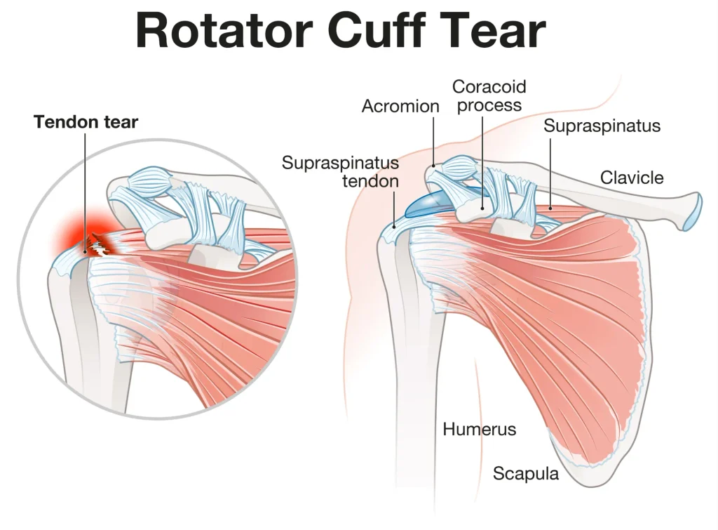 Diagram of rotator cuff tear